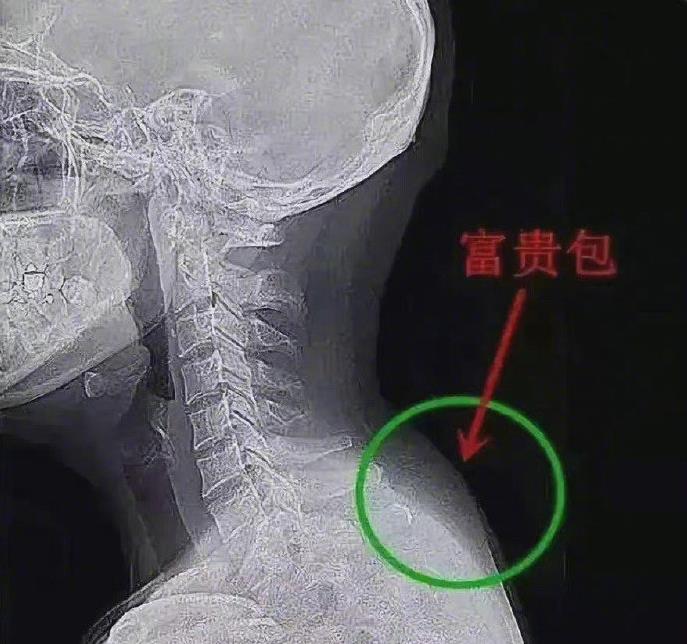 富贵包位置示意图，富贵包怎么消除最有效方法是什么